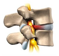 Позвоночник: грыжа межпозвонкового диска
