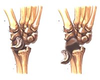 КОСТИ. Вывих полулунной кости. Переломы костей - фото