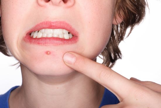 Как избавиться от прыщей на лице: проблемная кожа и ее лечение